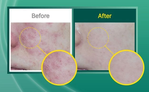 HYAAH Allinone Ectoin Lotion &ndash; зволожуючий лосьйон з ектоїном