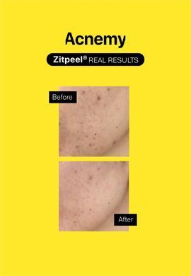 Acnemy ZITPEEL &ndash; кислотний незмивний пілінг для шкіри схильної до акне