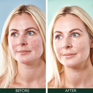 Sorted Skin 5 in 1 Anti-Redness Day Cream &ndash; денний крем проти почервонінь 5 в 1